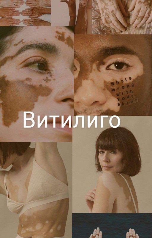 Витилиго